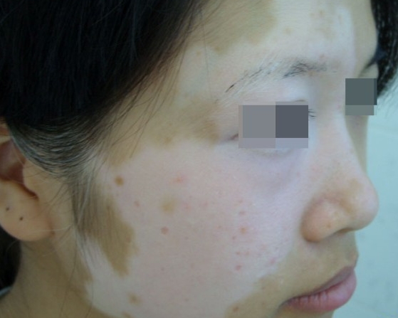 女性局限性白癜风有哪些原因