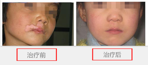 儿童白癜风该怎么判断