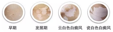 白癜风复发后有哪些症状