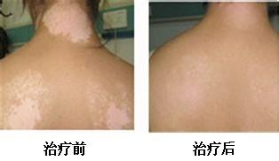 背部白癜风如何有效治疗